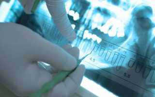 Тонкости проведения имплантации зубов с применением 3D-технологии