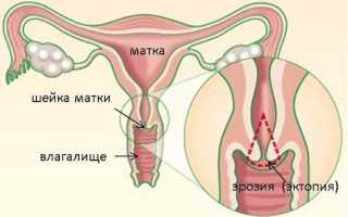 Основные причины, почему появляется эрозия шейки матки