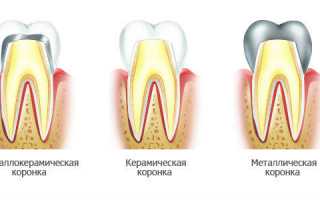 Сколько стоит вставить зуб – материал, виды протезирования и цена установки