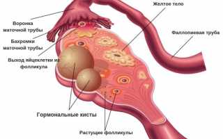 Как проводится пункция кисты яичника и зачем