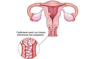 Явные и скрытые причины, почему молочница возвращается