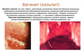 Почему появляются кровянистые выделения при молочнице