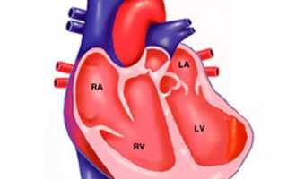 Острая аневризма сердца при инфаркте миокарда