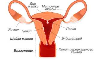 Почему появилась менструация со сгустками