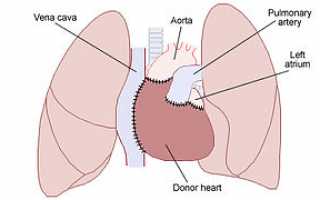 Пересадка сердца сколько живут после операции