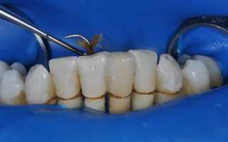 Что такое шинирование зубов. Фото «до и после»