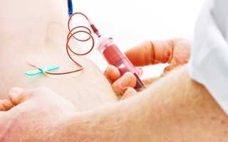 Как делают переливание крови при фурункулезе