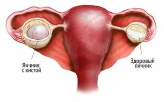 Нередкая находка на УЗИ — гормональная киста яичника: причины и лечение