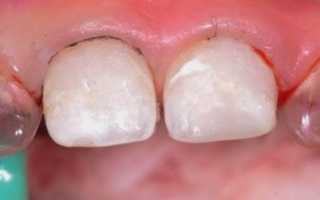 Делают ли протезирование молочных зубов?