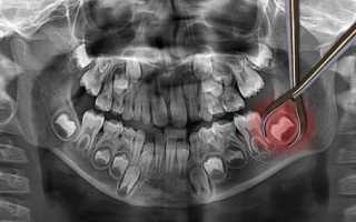 Больно ли удалять зуб мудрости? Советы пациенту