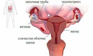 Как проводится выскабливание полости матки