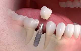 Какова вероятность отторжения зубного импланта в современной стоматологии