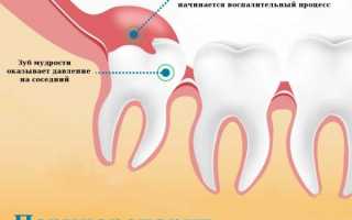 Неприятные симптомы прорезывания зуба мудрости — к чему может привести отказ от лечения