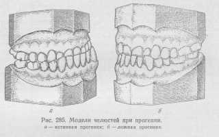 Какие опасности представляет прогенический прикус, и как не допустить осложнений