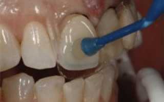 Цена устранения дефекта на 1 зубе с помощью люминира
