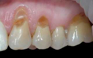 Особенности лечения клиновидного дефекта зубов