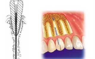 Суть использования эндодонтически стабилизированных имплантатов
