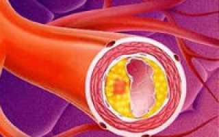 Атеросклеротическое уплотнение стенок аорты