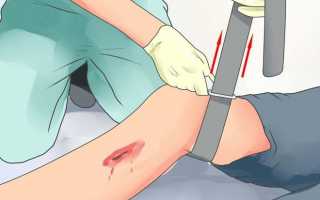 Как накладывать жгут при венозном кровотечении