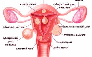 Что происходит во время беременности при миоме матки