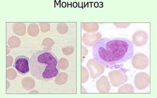 Моноциты и тромбоциты повышены у взрослого