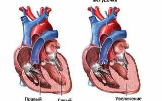 Увеличение левого желудочка сердца лечение