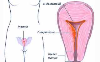 Что такое гиперплазия эндометрия, пути ее лечения