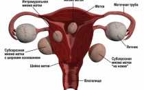 Варианты удаления матки и особенности жизни после операции