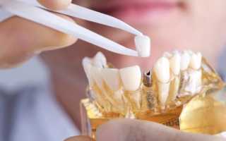 Сколько в реальности стоит имплантат зуба – от чего зависит его цена?
