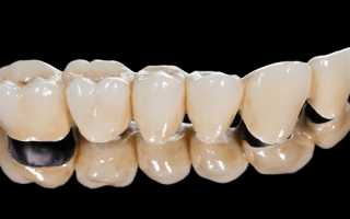 Виды зубных мостов – как выбрать лучший вариант
