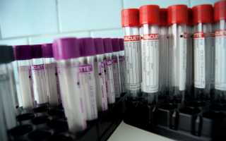Как сдавать клинический анализ крови подготовка