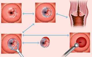 Что такое эктропион шейки матки