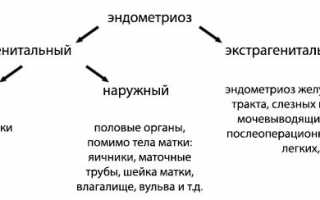 Взаимосвязан ли эндометриоз и рак