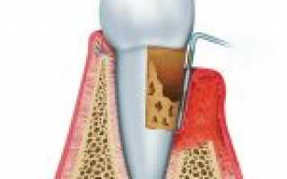 Рецессия десны: что это, как происходит лечение?