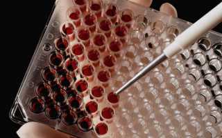 Биохимический анализ крови асло расшифровка
