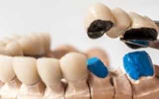 Когда оправдано замещение утраченных зубов паяными протезами?