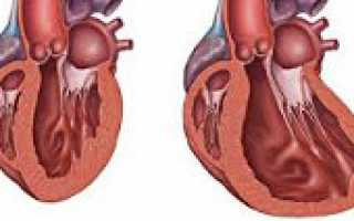 Эхокг признаки дилатационной кардиомиопатии