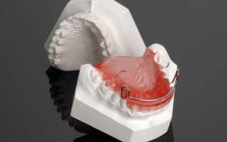 Бионаторы и другие ортодонтические съемные устройства для коррекции зубочелюстных аномалий