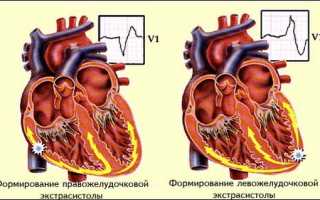 Экстрасистолия сердца что симптомы и лечение
