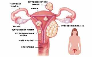 Характеристики многоузловой матки, методы ее лечения