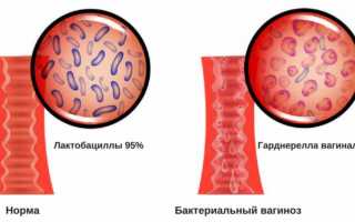 Как проявляется бактериальный вагиноз при месячных