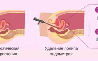 Основные последствия удаления полипа эндометрия с помощью гистероскопии
