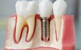 Эффективность метода базальной имплантации зубов — отзывы