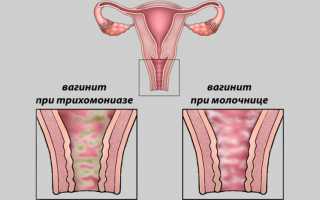 Виды и варианты лечения кольпита при беременности