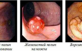 Как выявляется и лечится полип эндометрия в матке