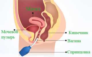 Рекомендации гинекологов, как правильно спринцеваться