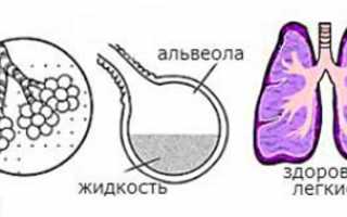 Что делать при токсическом отеке легких?